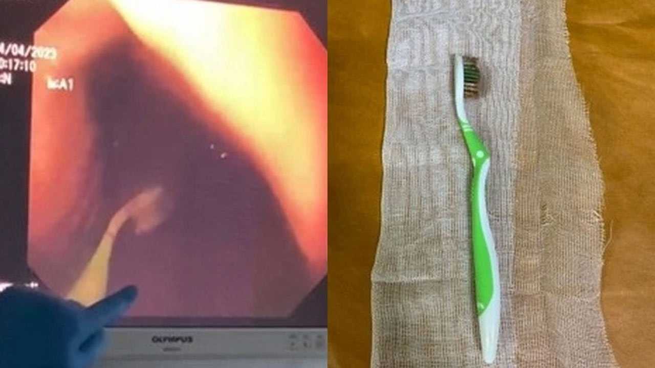 В Башкирии врачи извлекли зубную щетку из желудка пациентки