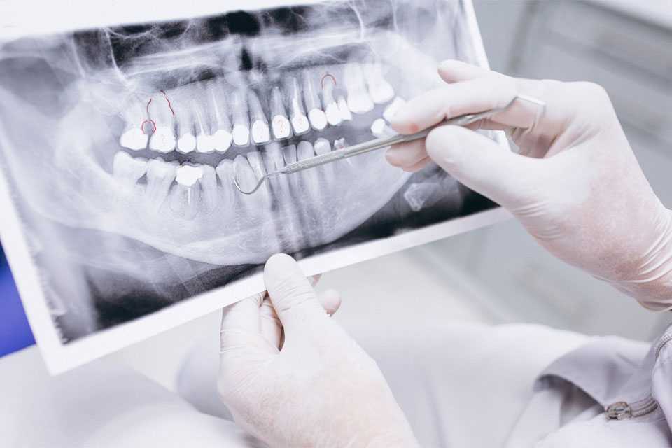 Удаление зуба: 3 неожиданных последствия, о которых вы не знали