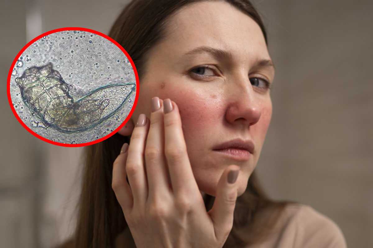 Неприятное соседство: дерматолог Зубова рассказала, кто живет на нашем лице