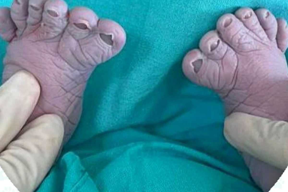 В Уфе родился мальчик с 12 пальцами на ногах